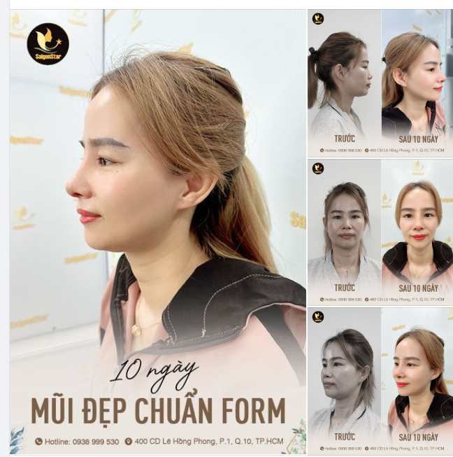 10 NGÀY MŨI ĐẸP CHUẨN FORM