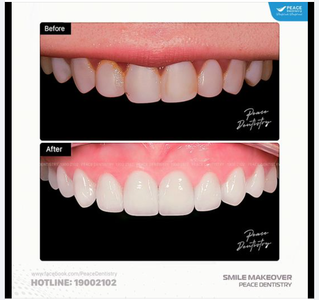 THÁO BỎ MẶT RĂNG COMPOSITE THAY BẰNG SỨ ZIRCAD PREMIUM (Made In Switzerland)