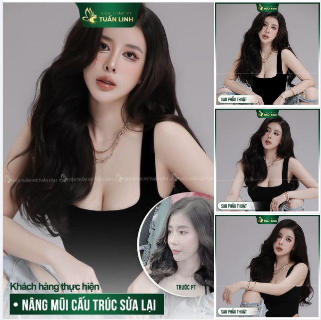Cô nàng H.T đẹp sang chảnh sau 1 năm nâng mũi sửa lại tại Tuấn Linh!