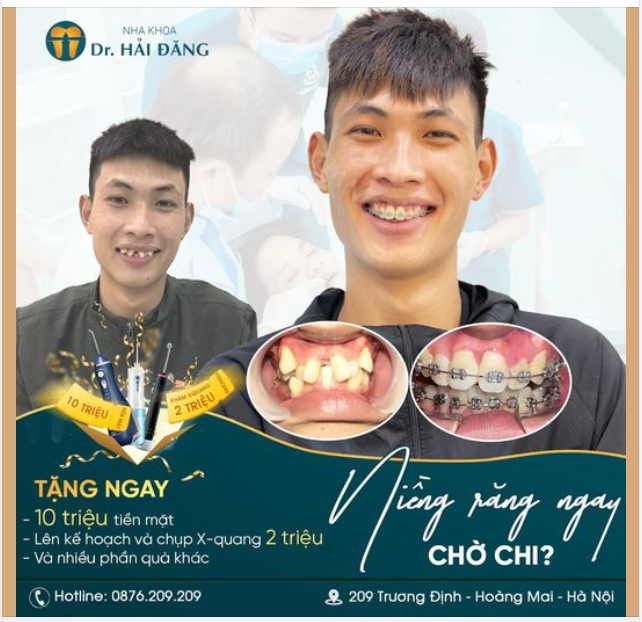""Bí Mật"" Nụ Cười Rạng Rỡ - Niềng Răng ""Đỉnh Cao"" Chỉ 10 Triệu