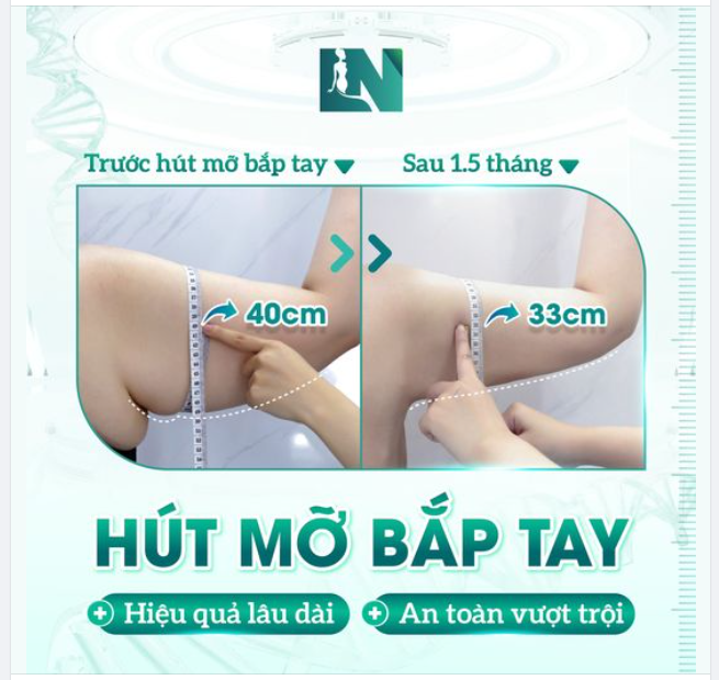 GIẢM NGAY 7CM BẮP TAY CHỈ SAU 1 LIỆU TRÌNH HÚT MỠ 60 PHÚT