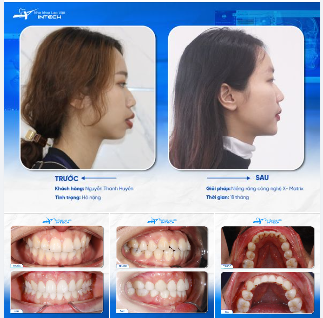 CÔ NÀNG 9X UPDATE NỤ CƯỜI HOÀN HẢO NHỜ CÔNG NGHỆ NIỀNG RĂNG MỚI NHẤT
