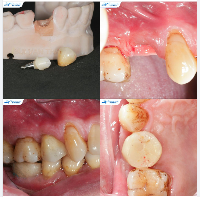 DIGITAL CUSTOMIZE - XU HƯỚNG MỚI TRONG TRỒNG RĂNG IMPLANT THỜI KỲ 4.0