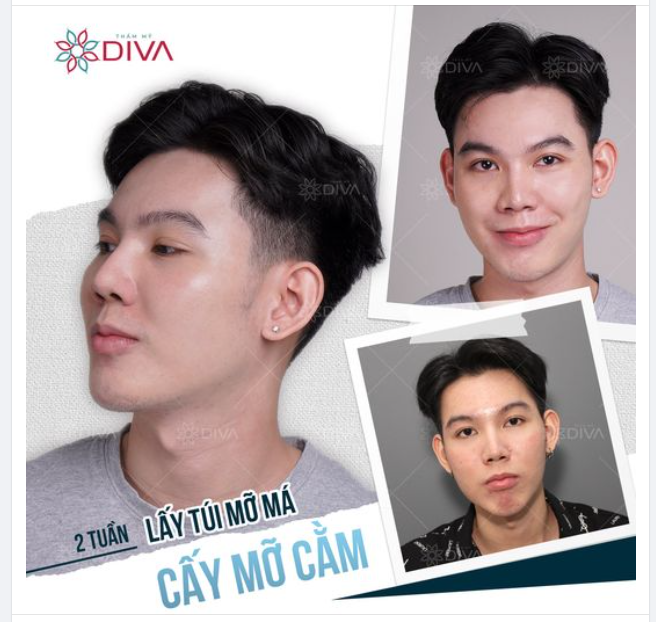 LẤY TÚI MỠ MÁ, CẤY MỠ CẰM: KẾT QUẢ SAU 10 NGÀY THẨM MỸ