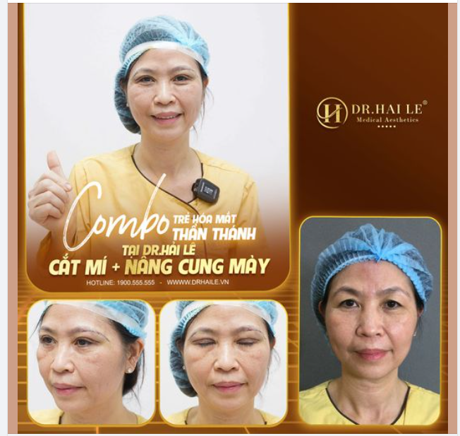 Combo trẻ hóa đôi mắt “thần thánh” cắt mí + nâng cung mày