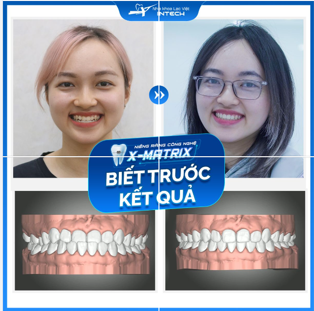 YÊN TÂM NIỀNG RĂNG NHỜ BIẾT TRƯỚC KẾT QUẢ VỚI CÔNG NGHỆ X-MATRIX