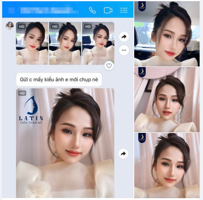 Nét đẹp duyên dáng, dịu dàng của khách nhà Latin sau hơn 1 tháng sửa mũi cấu trúc lót megaderm