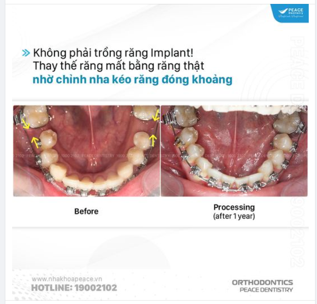 MẤT RĂNG NHƯNG KHÔNG PHẢI TRỒNG RĂNG GIẢ? NIỀNG RĂNG CÓ THỂ LÀM ĐƯỢC ĐIỀU ĐÓ!