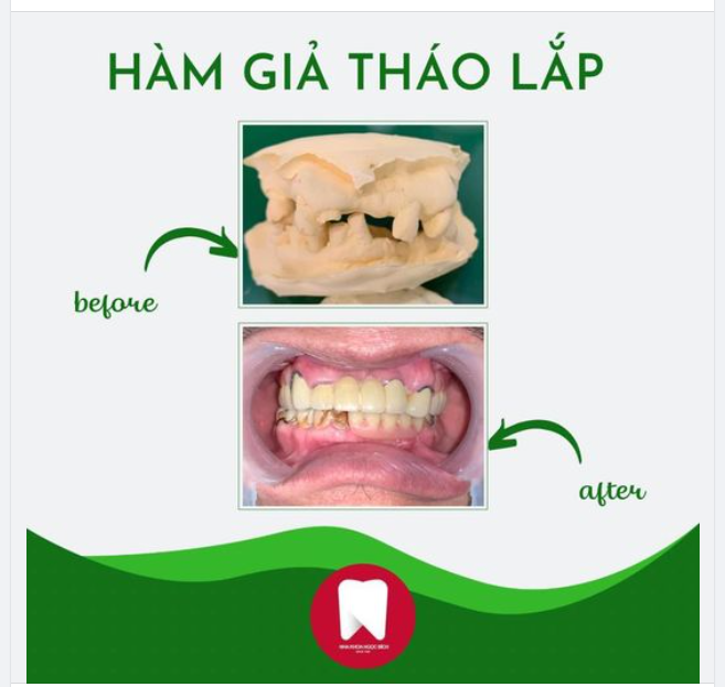 HÀM GIẢ THÁO LẮP, PHƯƠNG PHÁP PHỤC HÌNH RĂNG HƯ TỔN CHO NGƯỜI CAO TUỔI
