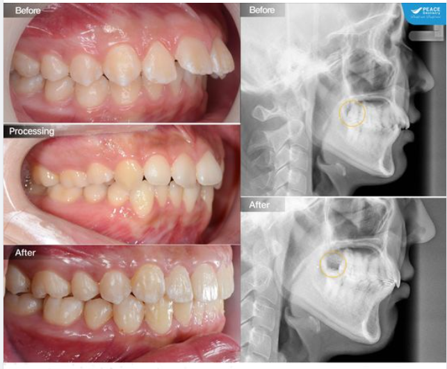 TẠI SAO NIỀNG RĂNG LẠI CẦN NHỔ RĂNG KHÔN?