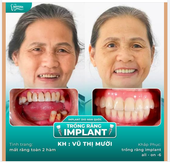 Trồng răng Implant toàn hàm All - On 6 khôi phục ăn nhai, thẩm mỹ hoàn hảo!