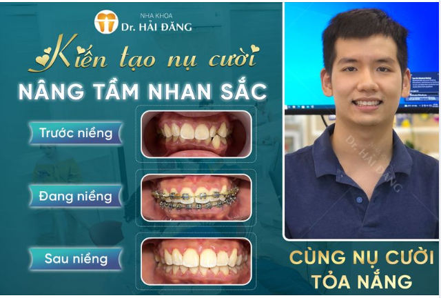 Niềng răng - Bí quyết tự tin cho nụ cười rạng rỡ