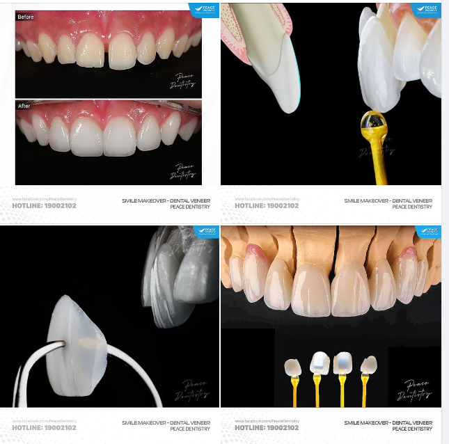 VENEER - LỰA CHỌN TUYỆT VỜI CHO RĂNG THƯA