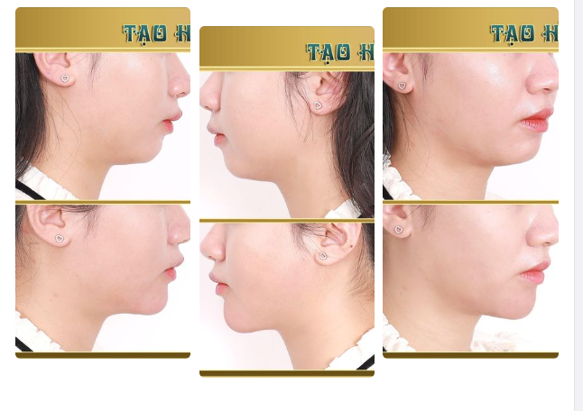 Tạo hình cằm V.line không ph.ẫu th.uật chỉ với 2cc filler và cái kết bất ngờ cho dung mạo tươi mới của quý Cô.