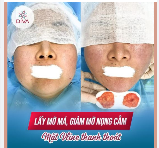 SAU LẤY MỠ MÁ, GIẢM MỠ NỌNG CẰM - GƯƠNG MẶT NHẸ NHÀNG, THON GỌN