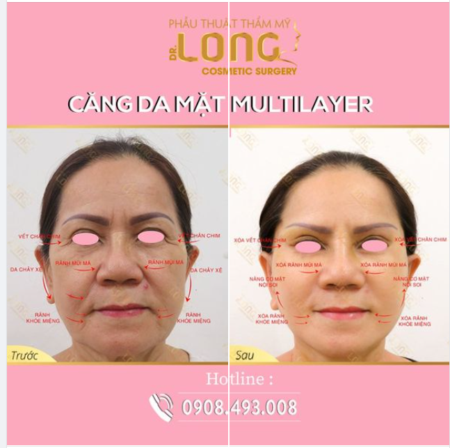 PHỤC HỒI “CẤP TỐC” DA CHẢY XỆ NHIỀU NẾP NHĂN