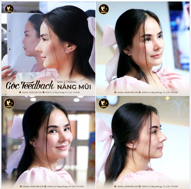 “Mờ ê mê…” dáng mũi sau 2 tháng. Cảm ơn chiếc feedback cực xịn từ chị khách Việt kiều Malaysia.