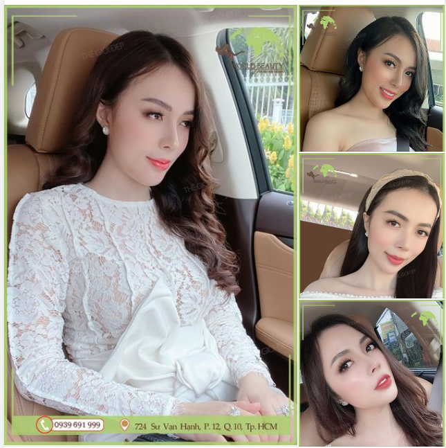Kết hợp hài hòa bộ đôi phẫu thuật Nâng mũi cấu trúc + độn cằm giúp quý cô sở hữu ngay kết quả ưng ý cho dung mạo