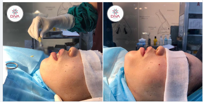 2 DỊCH VỤ LÀM ĐẸP "BEST SELLER" TẠI DIVA ?