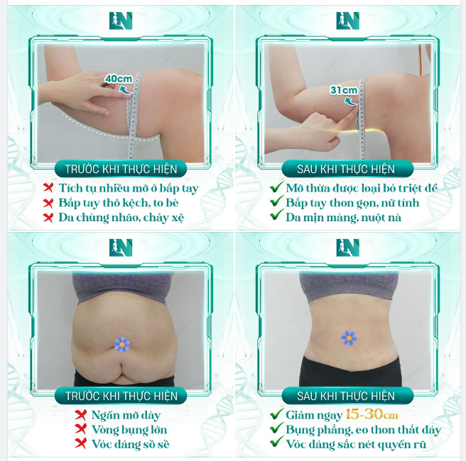 HÚT MỠ TẠO DÁNG - BÍ QUYẾT SỞ HỮU VÓC DÁNG HOÀN HẢO VẠN NGƯỜI MÊ