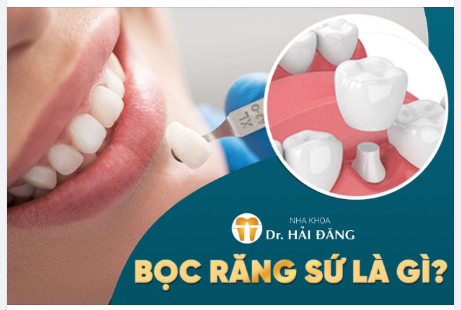 Bọc răng sứ bí mật giúp nhiều người tự tin tỏa sáng với nụ cười rạng rỡ