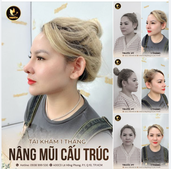 TÁI KHÁM 1 THÁNG SAU NÂNG MŨI CẤU TRÚC