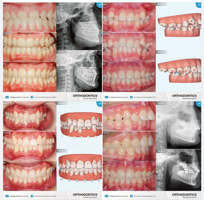 INVISALIGN NHỮNG CA CHỈNH NHA PHỨC TẠP