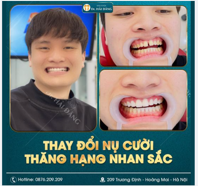 THAY ĐỔI NỤ CƯỜI THĂNG HẠNG NHAN SẮC