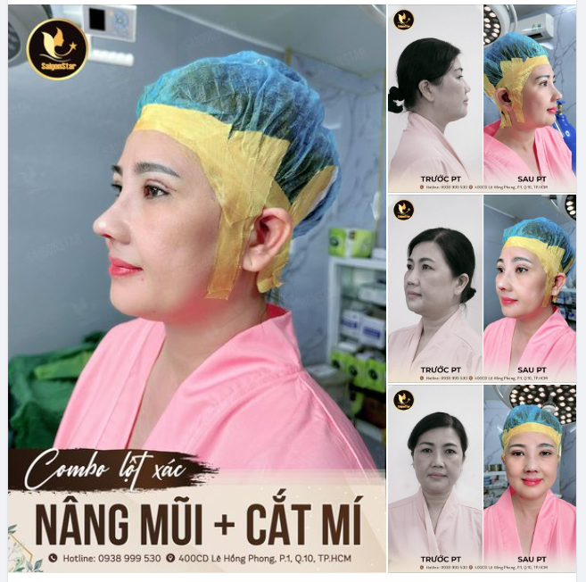 COMBO LỘT XÁC NÂNG MŨI + CẮT MÍ
