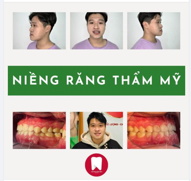 DỨT ĐIỂM TÌNH TRẠNG KHỚP CẮN NGƯỢC, THÊM MỘT NỤ CƯỜI TỰ TIN CHO KHÁCH HÀNG NHỜ NIỀNG RĂNG
