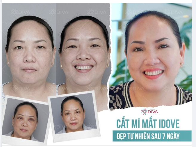 KẾT QUẢ CẮT MÍ MẮT - ĐẸP TỰ NHIÊN SAU 7 NGÀY