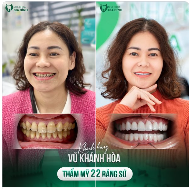 TRẺ RA CHỤC TUỔI NHỜ VIỆC THAY ĐỔI NỤ CƯỜI