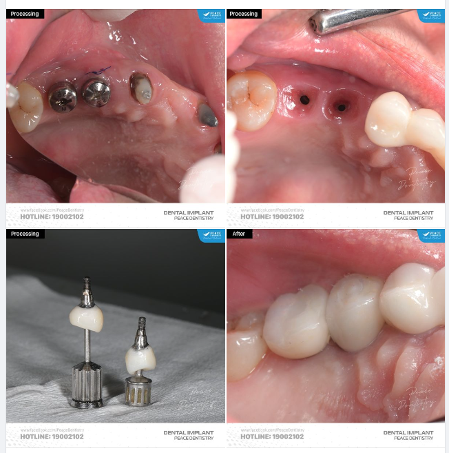 PHỤC HÌNH TRÊN IMPLANT CÓ VAI TRÒ QUAN TRỌNG QUYẾT ĐỊNH KẾT QUẢ SAU CÙNG CỦA MỘT CA