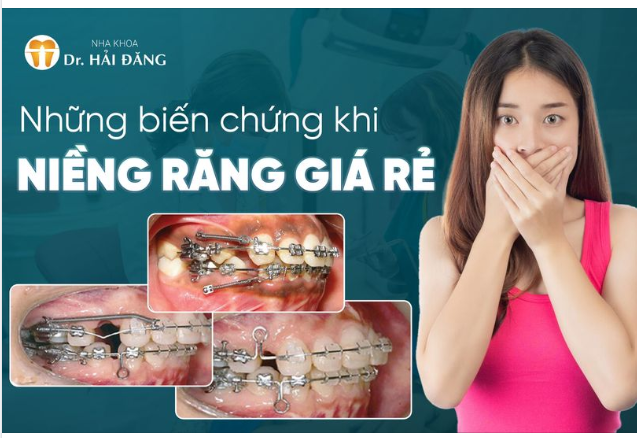 Niềng răng giá rẻ: Tiết kiệm hay tiền mất tật mang?