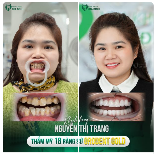 ĐÚNG ĐẮN KHI ĐÃ QUYẾT ĐỊNH LÀM RĂNG SỨ TRONG THỜI ĐIỂM NÀY