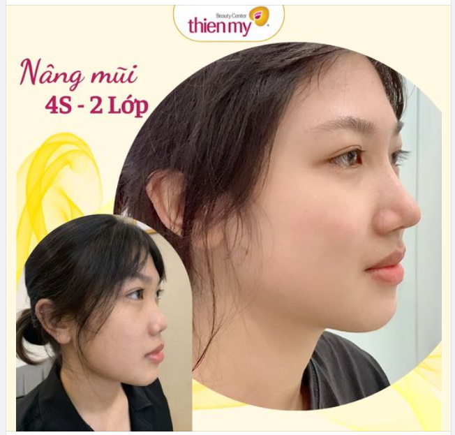 Ưu điểm của phương pháp nâng mũi 4S-2lớp kết hợp khâu chóp: