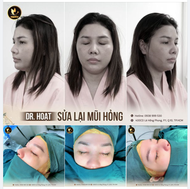 DR. HOẠT SỬA LẠI MŨI HỎ.NG