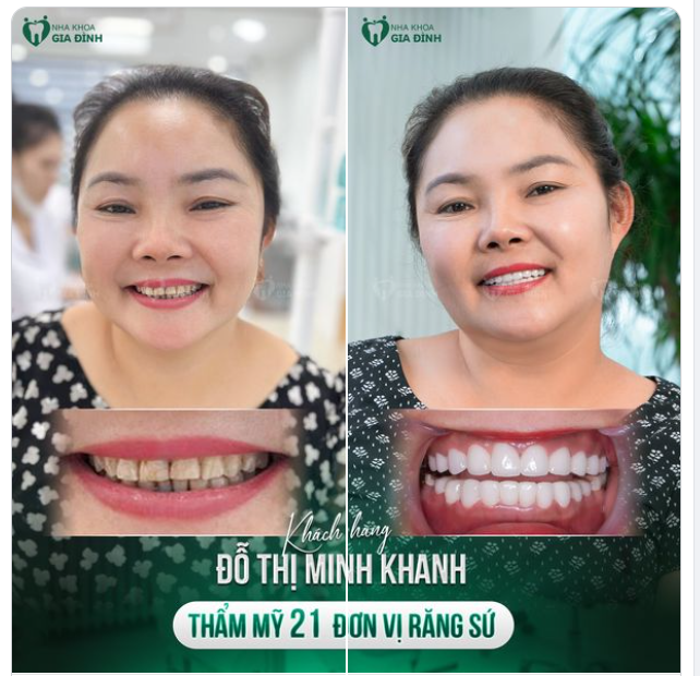 TẠM BIỆT MỌI KHUYẾT ĐIỂM TRÊN RĂNG DÙ LÀ NHỎ NHẤT