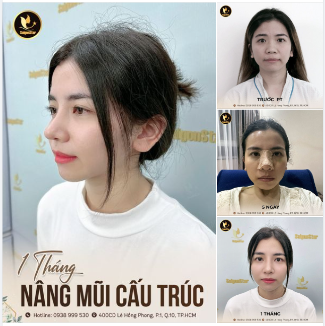 HÌNH ẢNH CHÂN THỰC ĐẾN TỪNG MILIMET KẾT QUẢ NÂNG MŨI CẤU TRÚC SAU 1 THÁNG