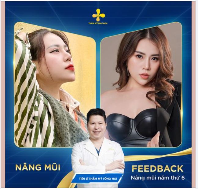 Dáng mũi làm từ năm 2019, sang đến năm 2024 trông sẽ như thế nào?