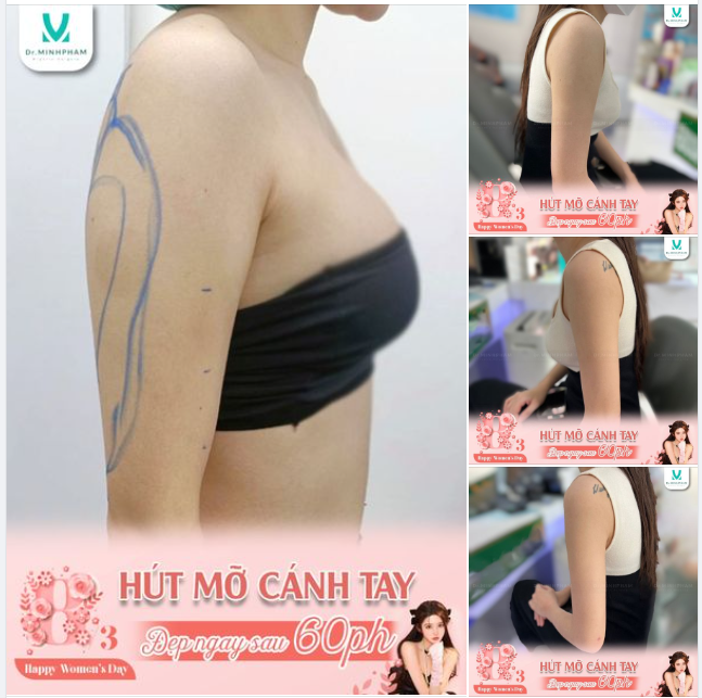 HÚT MỠ CÁNH TAY. Đẹp ngay chỉ sau 1 lần thực hiện.