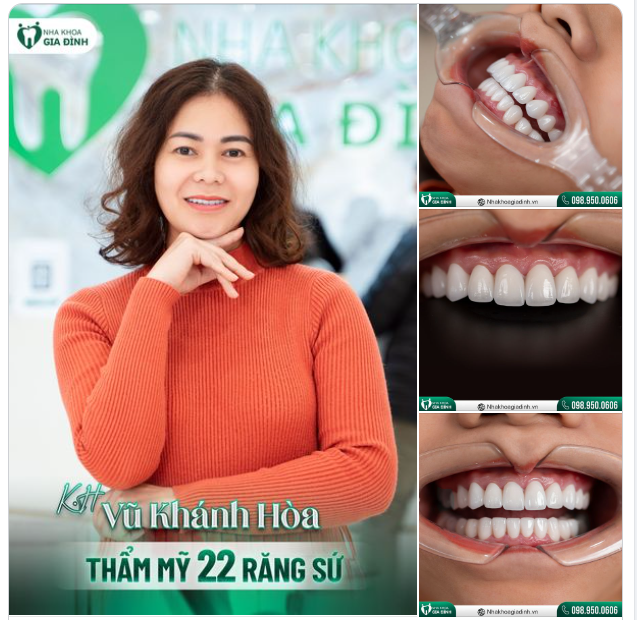 Không cầu kỳ trong việc phải sở hữu nụ cười "flexing" hào nhoáng, chị Hòa lựa chọn dòng sứ tinh tế giúp bảo tồn tối đa răng gốc tự nhiên mà vẫn đảm bảo yếu tố thẩm mỹ tuyệt vời.