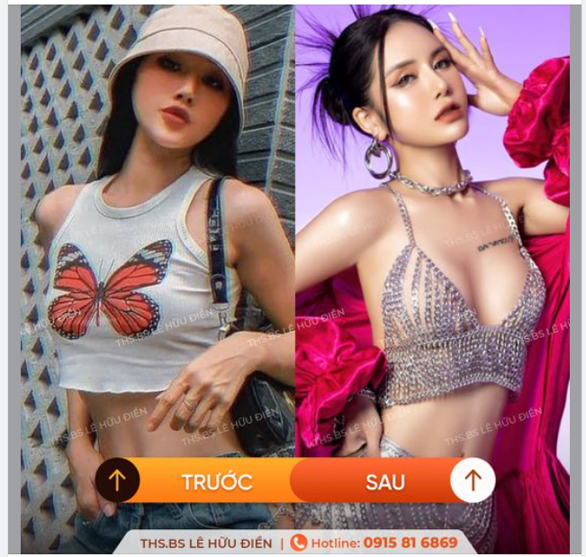 DJ Linh Kem trước và sau khi nâng ngực tại DrD.