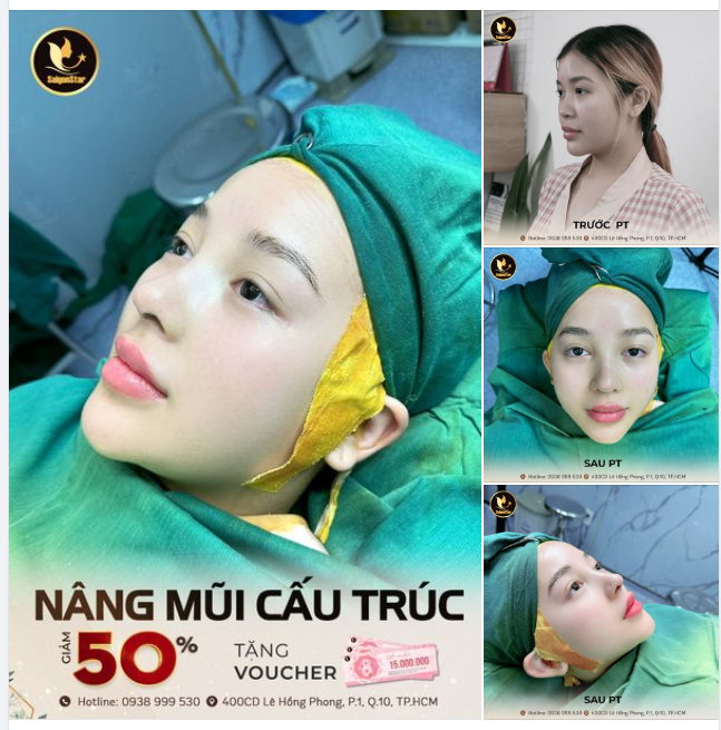 GIẢM 50% NÂNG MŨI CẤU TRÚC TẶNG VOUCHER ĐẾN 15TrĐ