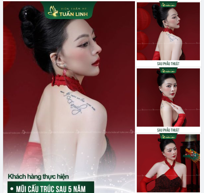 Nâng mũi bền đẹp - Gọi tên Tuấn Linh!!