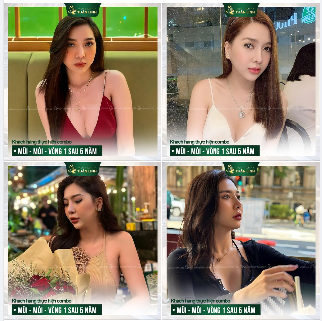 Nâng mũi + cắt môi + Nâng V1 tại Tuấn Linh  Combo Đẹp Sang - Bền Chắc!!