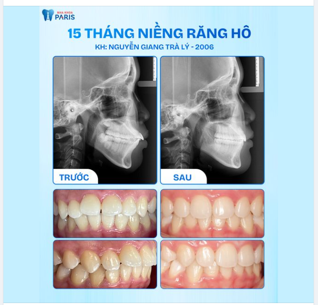 Nhìn ảnh chụp phim để thấy rõ kết quả mỹ mãn chỉ sau 15 tháng Niềng khay trong Invisalign  của cô gái 2k6!