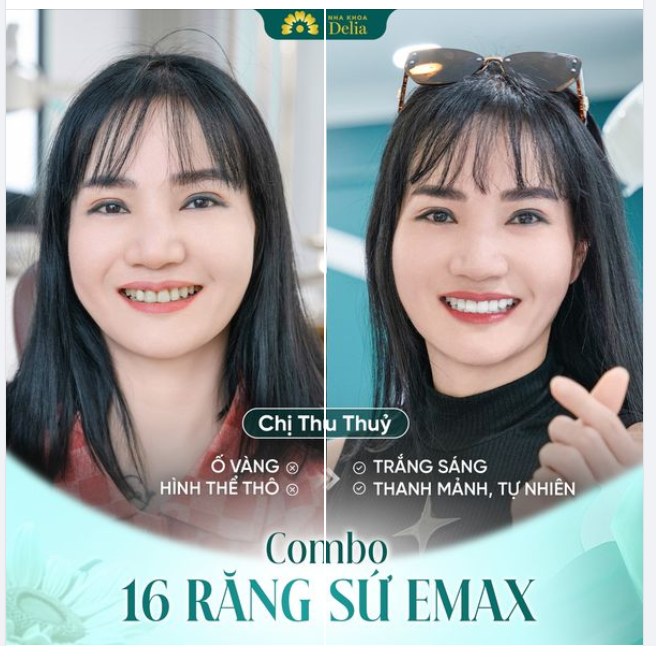 Khắc phục răng ố vàng chỉ sau 48H làm răng sứ