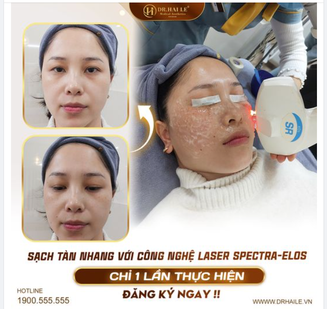 Có nhiều người trị tàn nhang bằng rất nhiều cách nhưng không khỏi nên khi đến Dr.Hải Lê trị tàn nhang cũng nghĩ rằng "kể cả hiệu quả thì 2-3 lần mới thấy rõ "