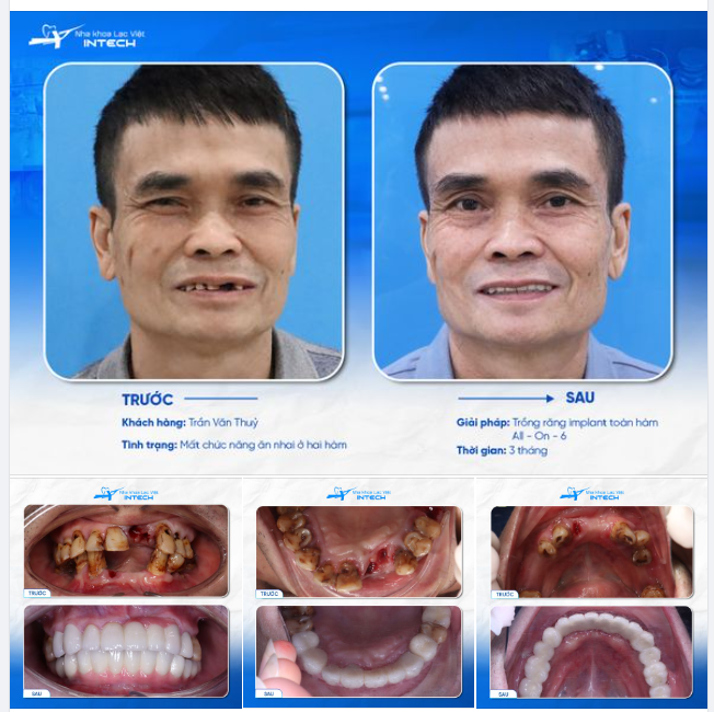 SỤT CÂN NGHIÊM TRỌNG VÌ MẤT RĂNG, NGƯỜI ĐÀN ÔNG TÁ HOẢ ĐI TÌM GIẢI PHÁP